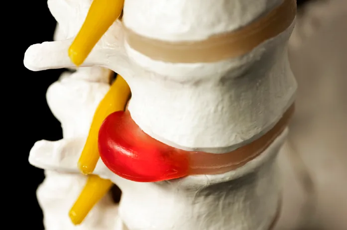 Diagram of a bulging spinal disc pressing on a nerve root