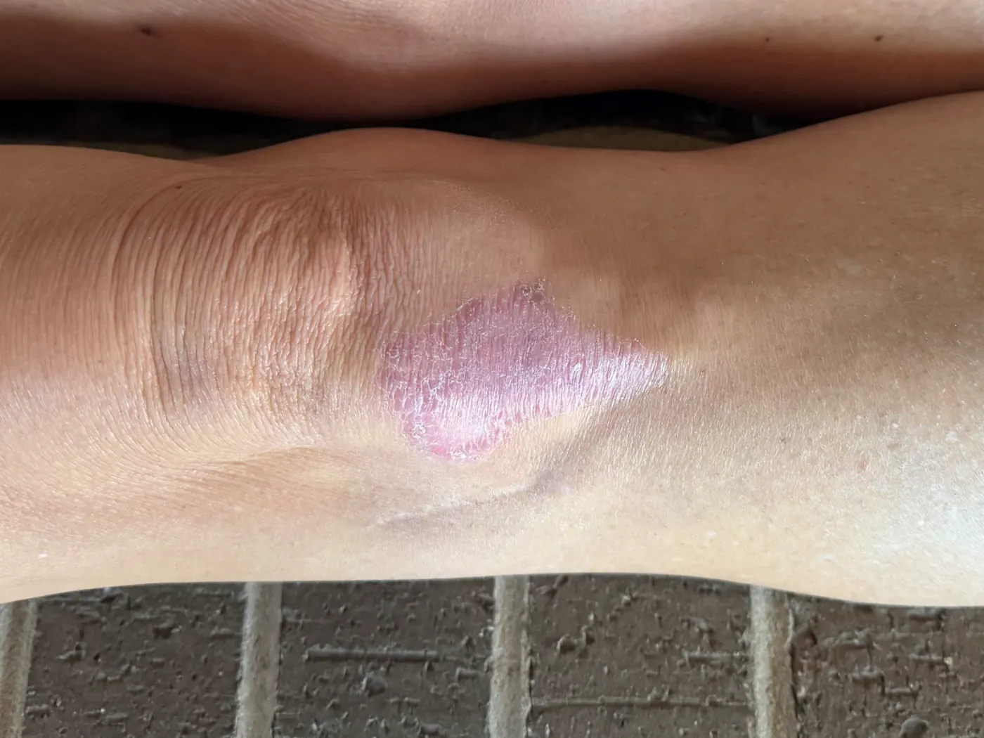 The same knee after a course of treatment, closed and healed over with pale scar tissue