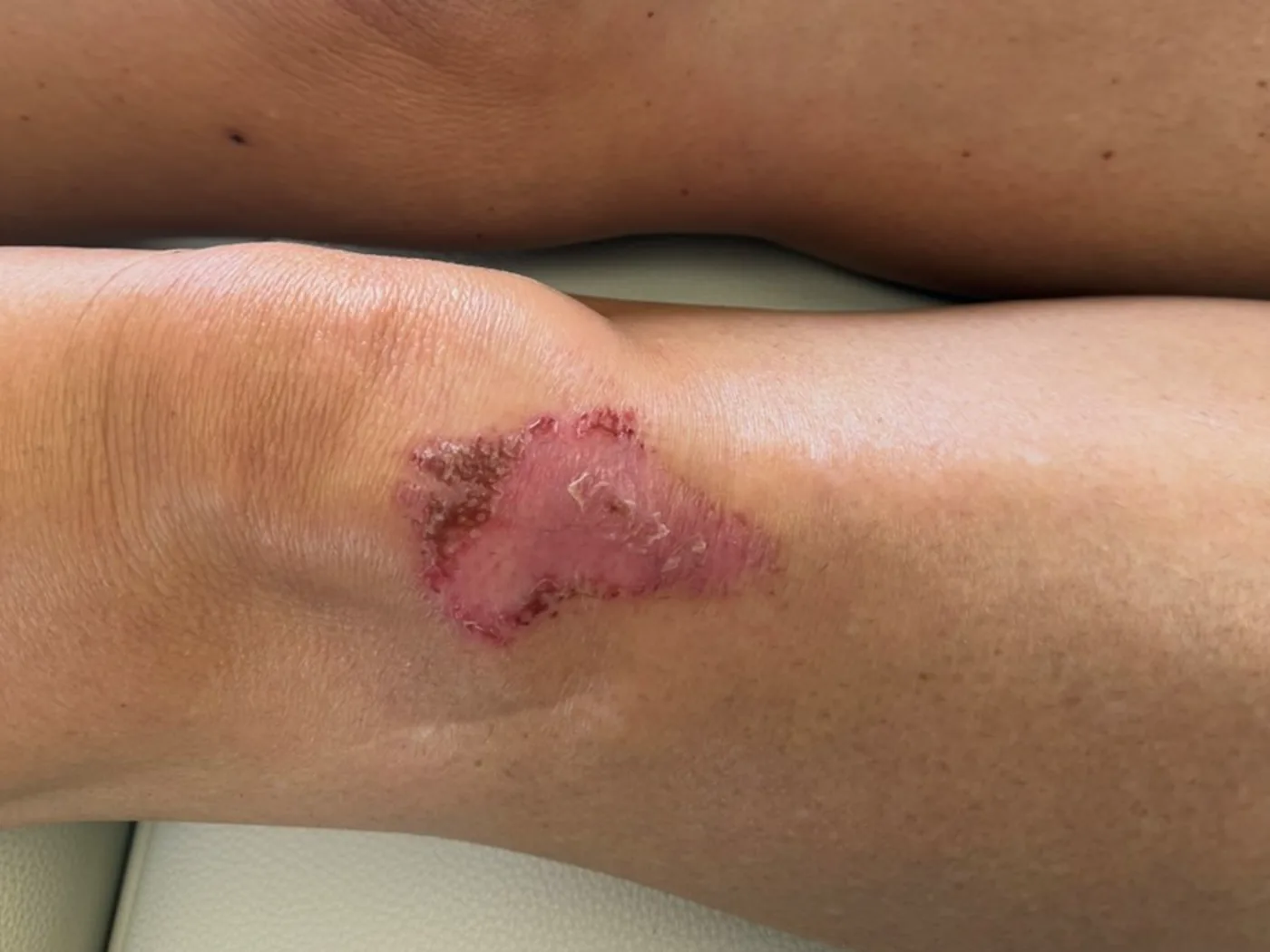 Terra’s knee before treatment, with an open, raw lesion across the joint