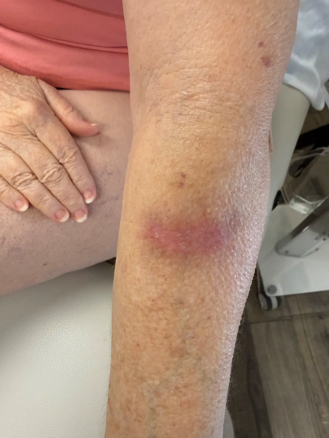 The same area after a course of laser therapy, with the wound closed and the skin healed over