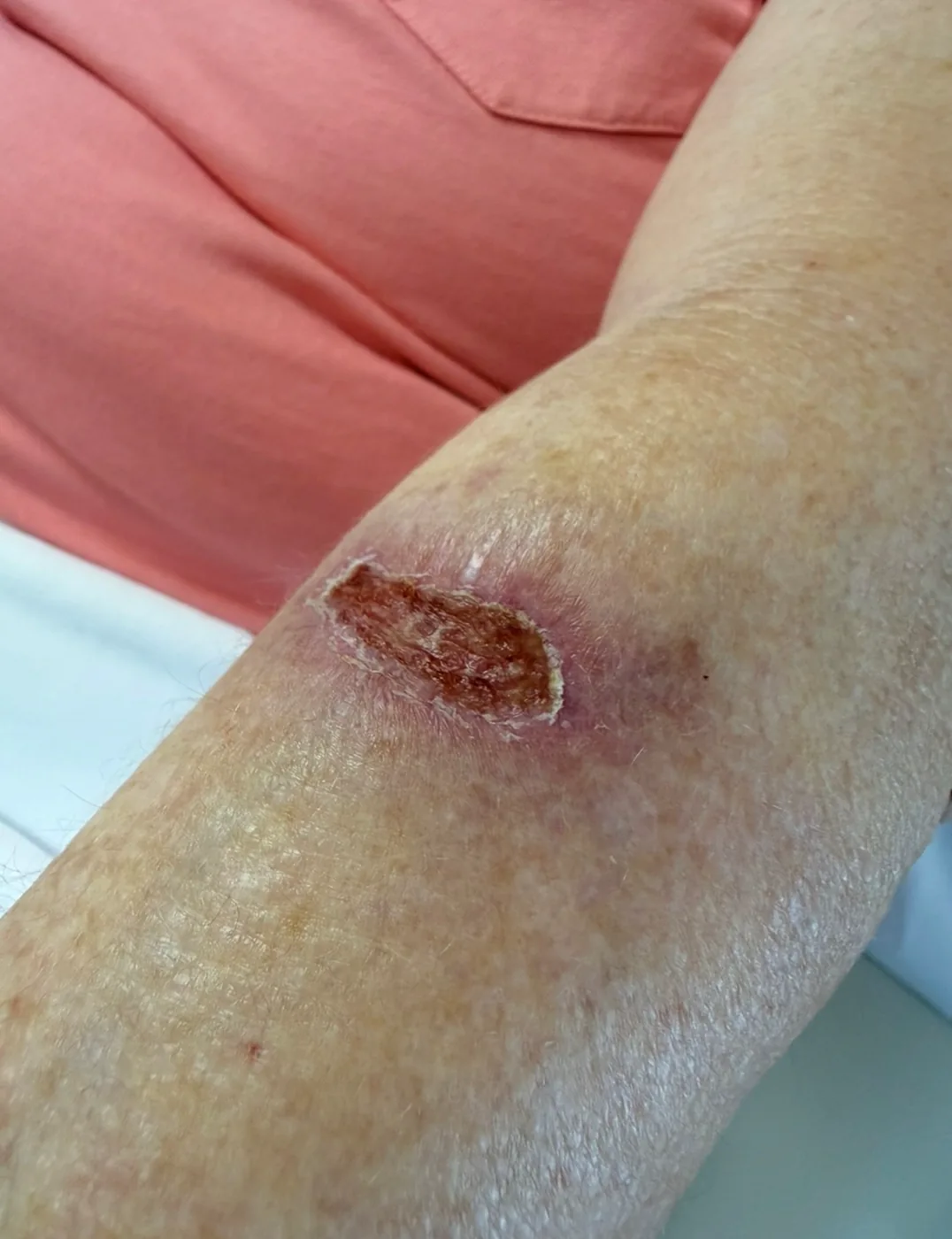 A patient’s limb with an open, slow-healing wound, photographed before laser therapy began